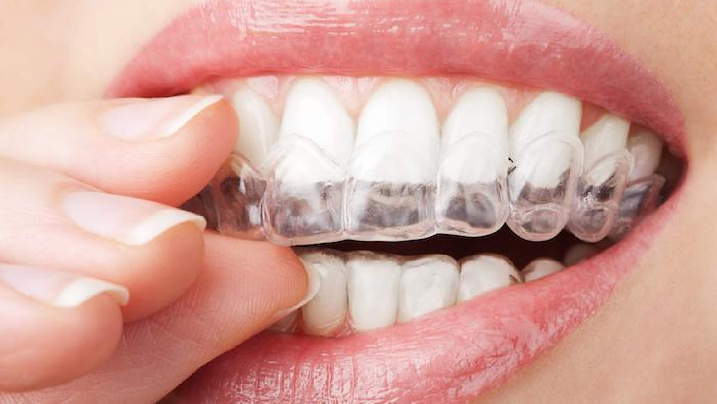 Blind comfort Neuken Je tanden rechtzetten zonder blokjes dankzij Invisalign | Orthopolis